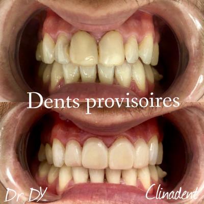 couronnes provisoires dentiste Avignon 