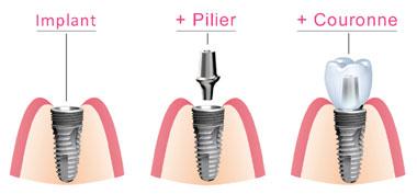 Composants implant dentaire à Avignon